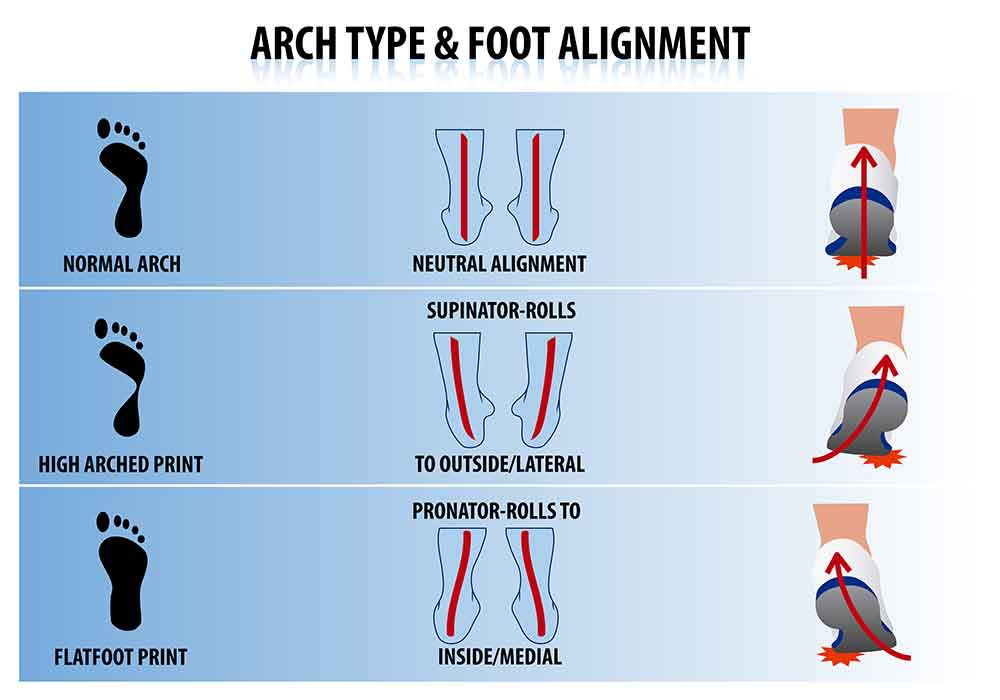 Your arches will determine your gait and foot landings while running..