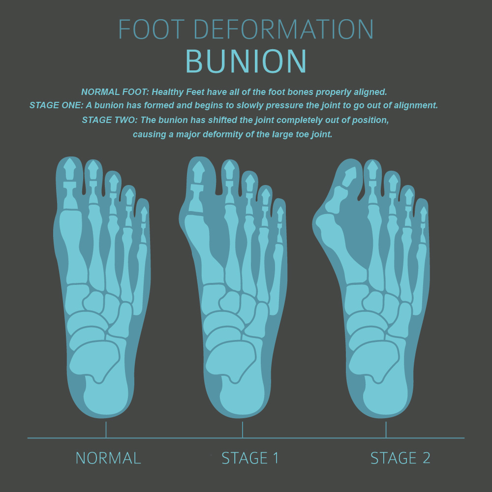 Diagram showing the progressive stages of a Bunion.