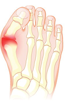 Foot with big toe leaning inward crossing over other toes