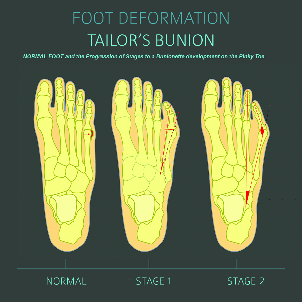 Graphic showing the developmental stages of a bunionette.