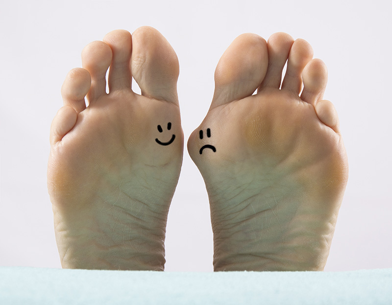 Bunions: When is the best time to have surgery? | Top Doctors