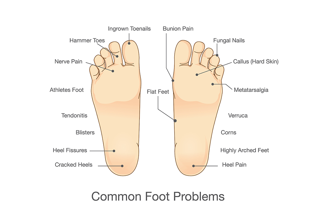 Common Foot Ailments Chart