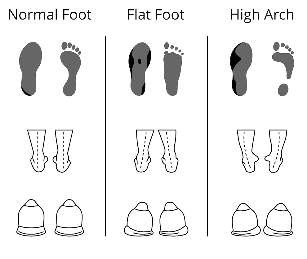 You can find insoles for normal arches, high arches and fallen arches