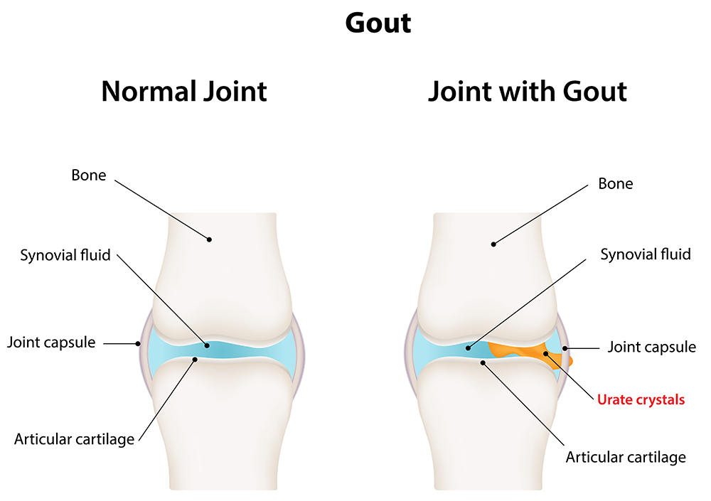 A normal joint vs. a joint afflicted by Gout