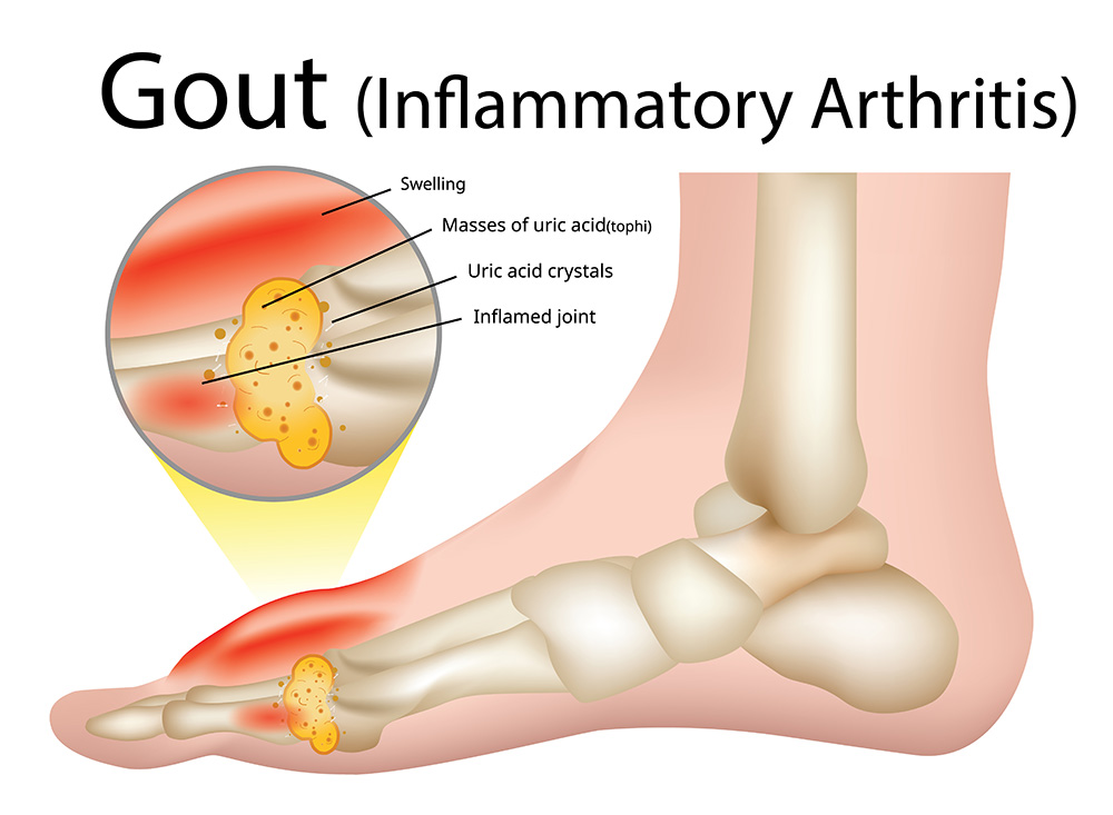 Gout is caused by an excess build-up of uric acid in the foot joint