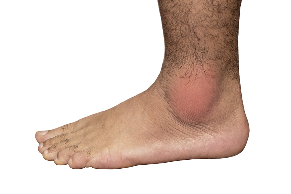 Gout in the ankle joints can become inflamed and swollen