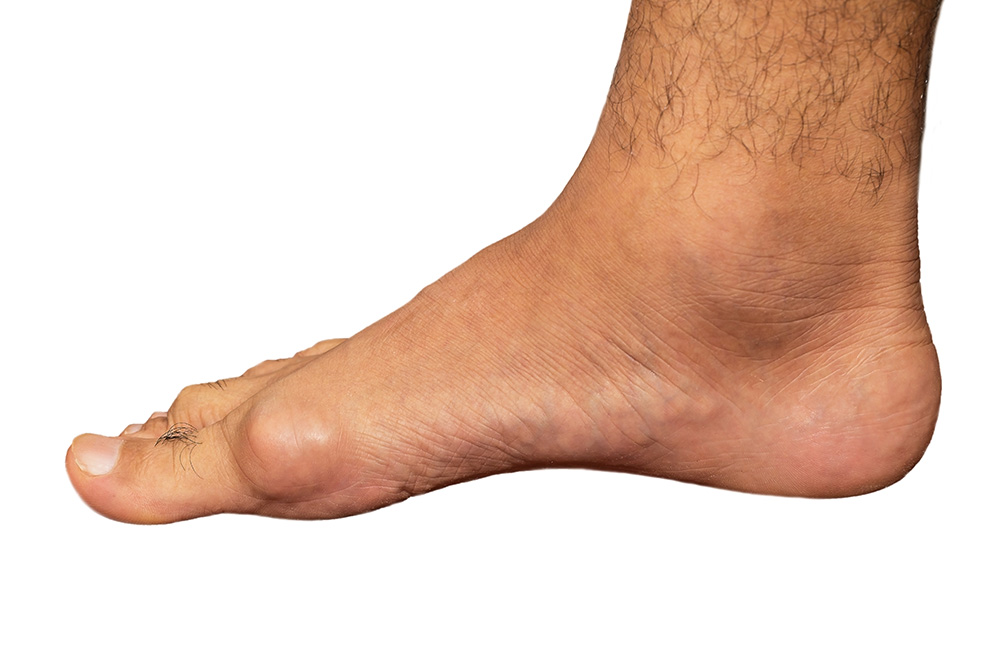 Gout Symptoms Foot Picture