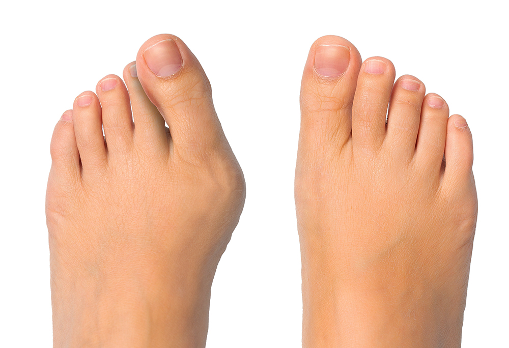 Comparing a foot with a bunion deformity to a normal foot