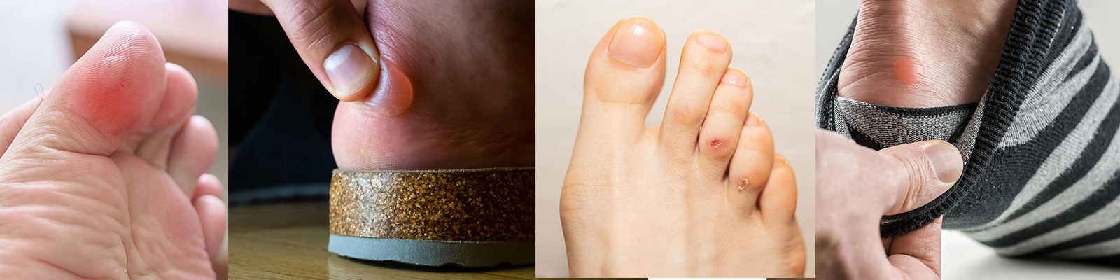 Different types of blisters can form from tight fitting shoes.
