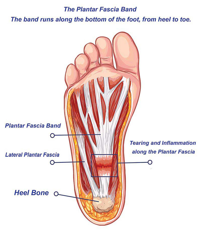 The Plantar Fascia Band Runs the Entire Length Underfoot