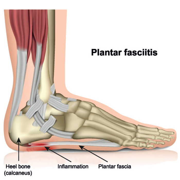 The Plantar Fascia runs under the foot, attaching the Heel to the Toes