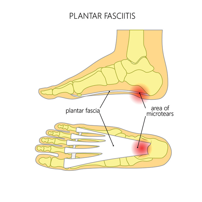 The Pain of Plantar Fasciitis can occur from Tiny Microtears in the Fascia Band