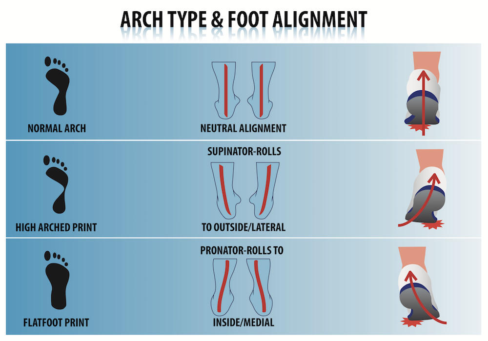 Chart depicting different arch types and foot alignments