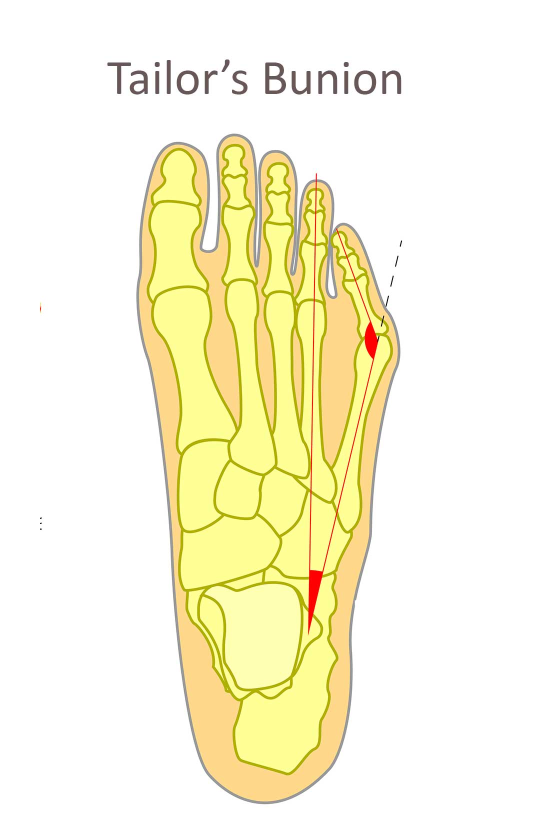 A tailors bunion causes the littlest toe to bend inward across the foot